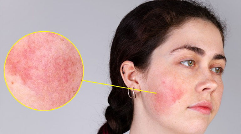 czerwone policzki - just be fit