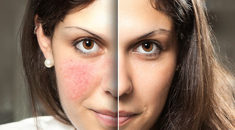 Cera naczynkowa kobiety z czerwonymi policzkami