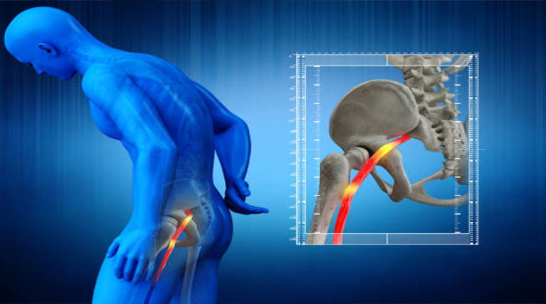 ucisk nerwu kulszowego pokazany na kościach człowieka