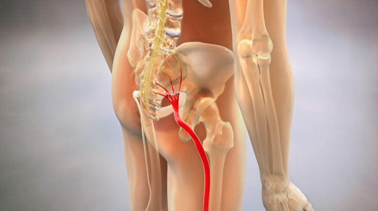 rwa kulszowa co to jest