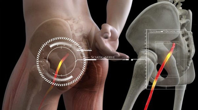 nadmierne wygięcie kręgosłupa lędźwiowego
