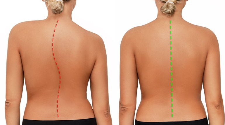 boczne skrzywienia kręgosłupa