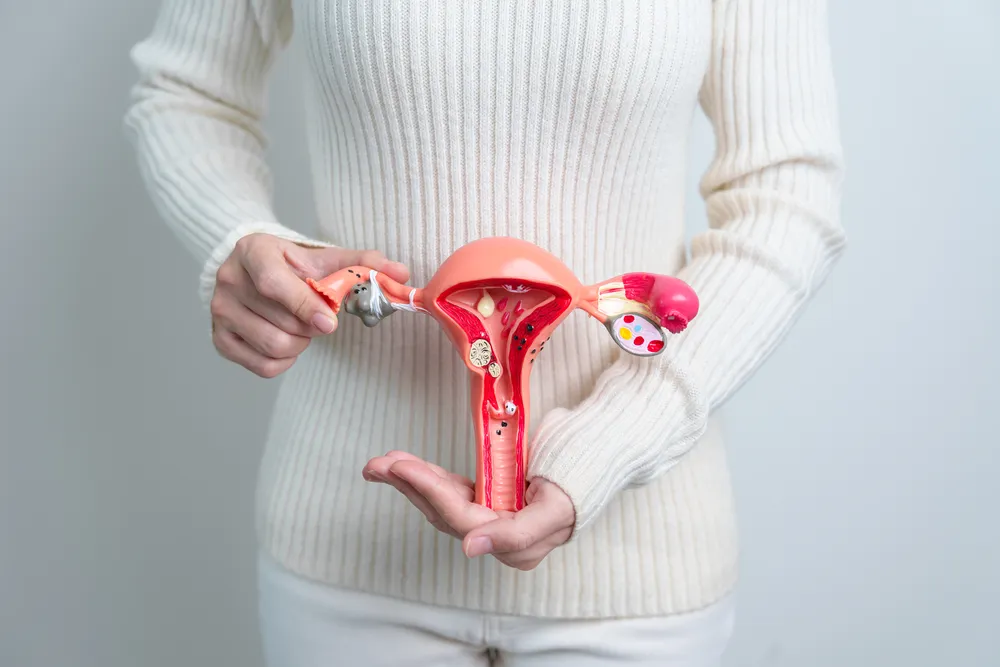 PCOS jako przykład choroby spowalniającej odchudzanie