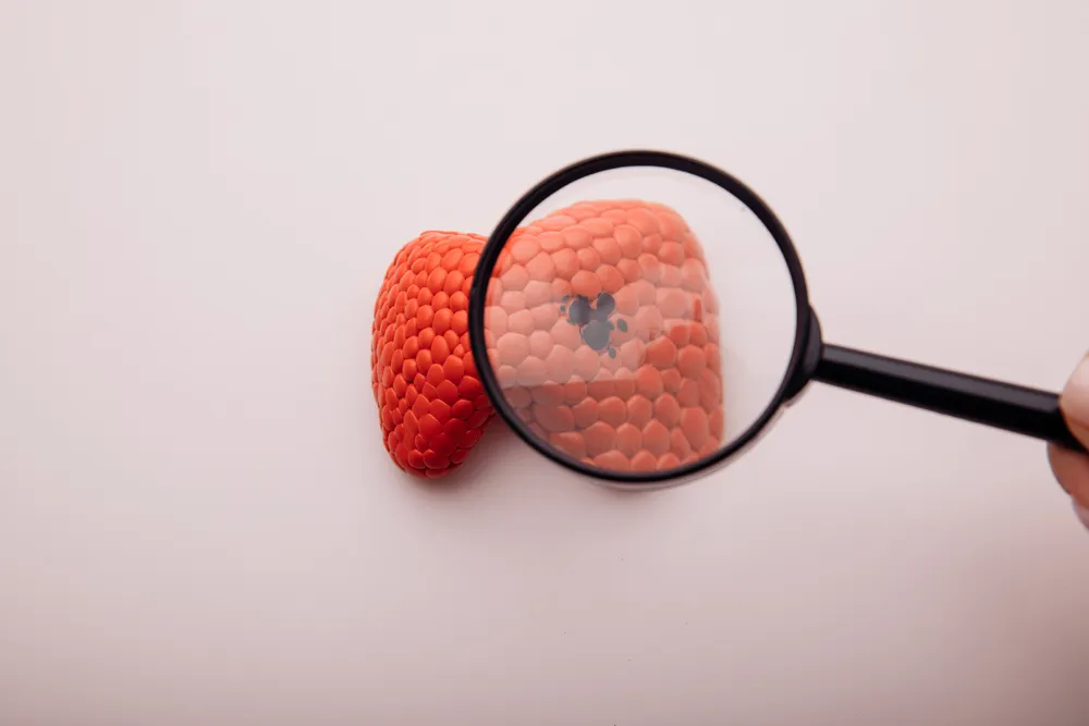 Hashimoto co to jest i jak zagraża tarczycy